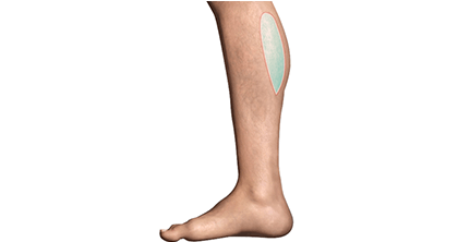 Calf Implants