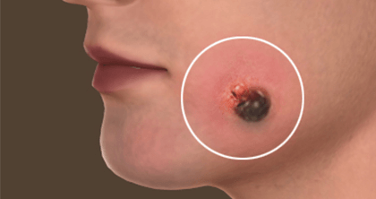 Skin Cancer and Melanoma Surgery