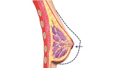 Breast Reduction