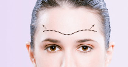 Brow Lift