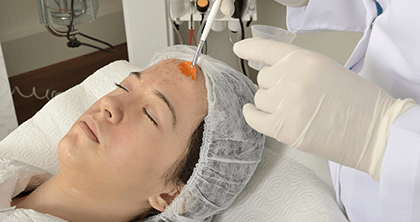 Facial Peels