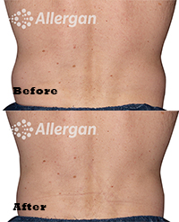 10 weeks after 2nd CoolSculpting® session
