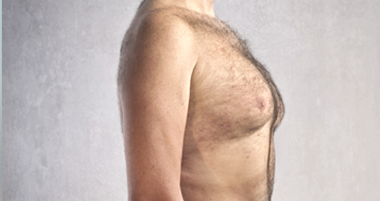 Gynaecomastia