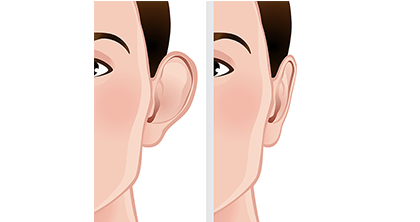 Otoplasty