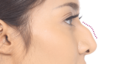 Rhinoplasty